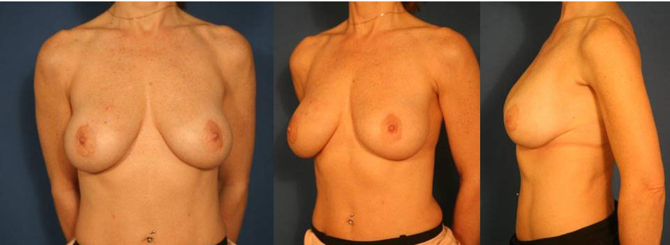 Breast Augmentation with Fat Cell Transfer 6 Year Case Study in Charlotte, NC