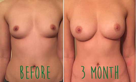 Facts About Fat Cell Transfer for Breast Augmentation.