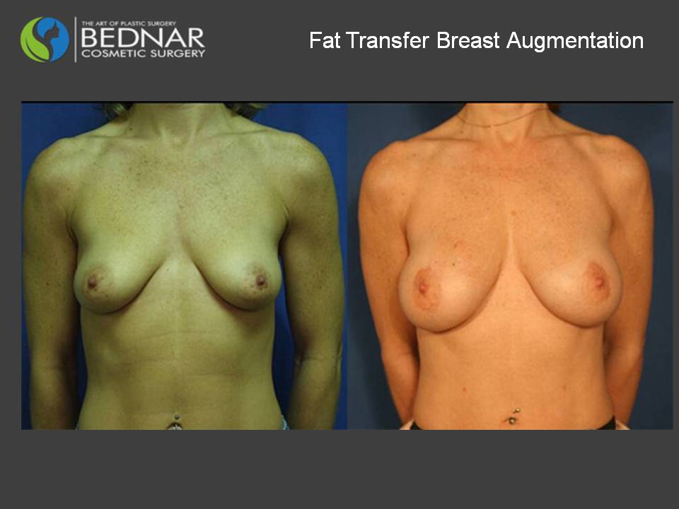 Fat Cell Transfer Breast Augmentation Photos in Charlotte, NC