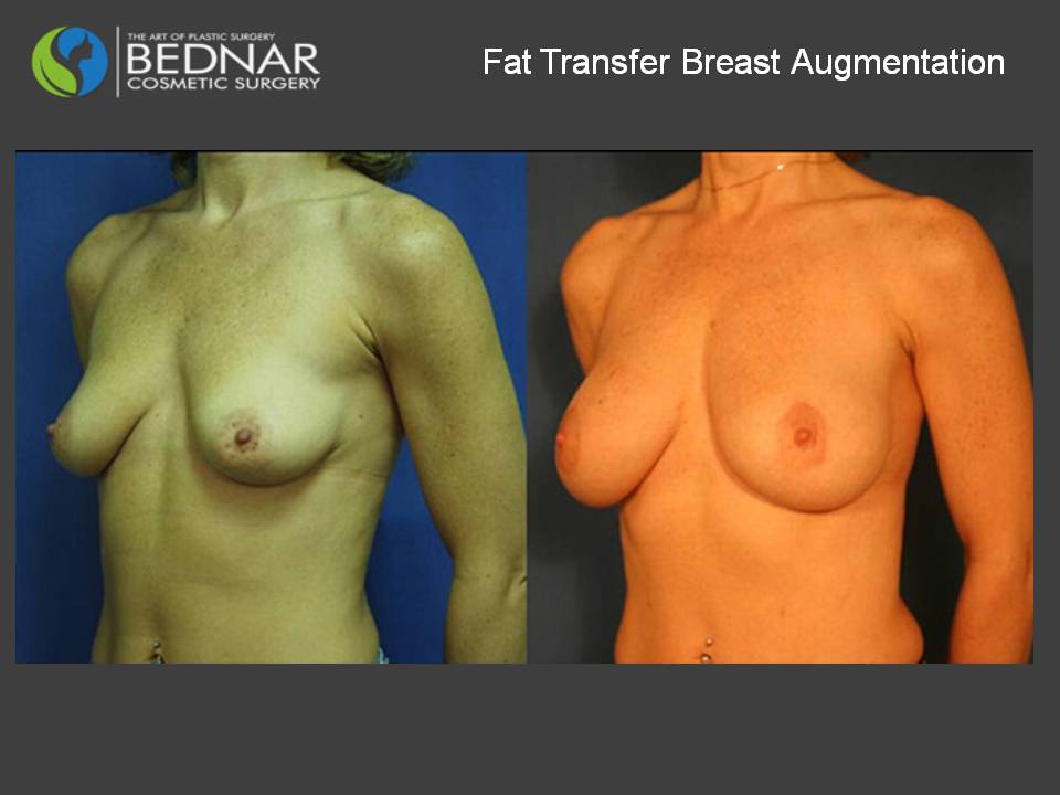 Fat Cell Transfer Breast Augmentation Photos in Charlotte, NC