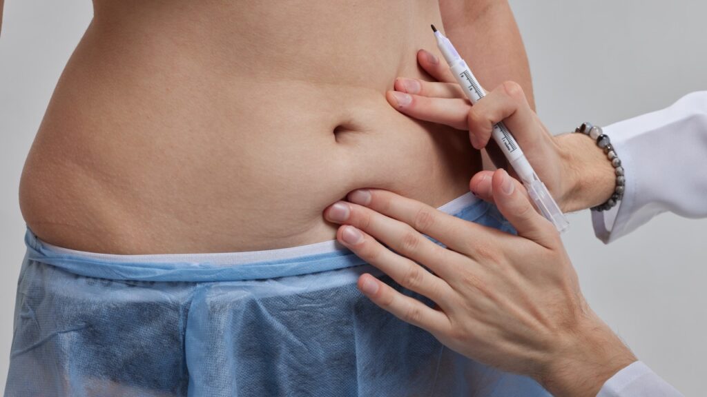 What is Liposuction